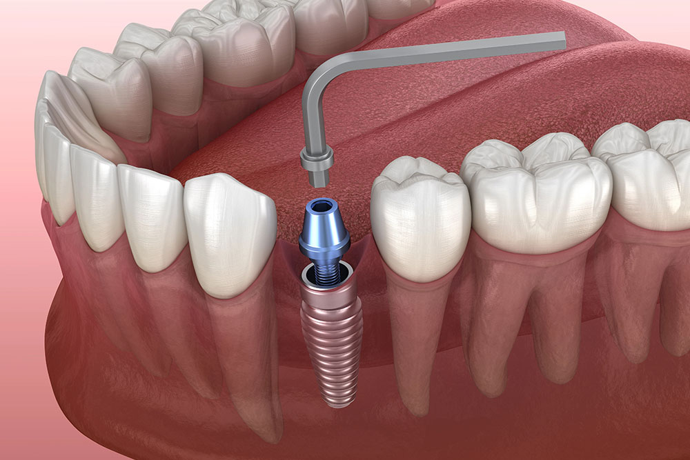 5-common-mistakes-to-avoid-when-placing-dental-implants